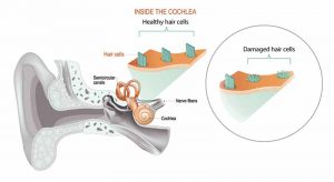 The human ear basically consists of three parts: the external ear, middle ear, and inner ear. This cross section shows the hair cells that transform the sound vibrations in the fluids of the cochlea into electrical signals that are then relayed via the auditory nerve to the brain.